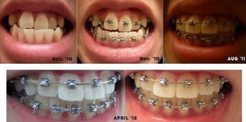 Niềng răng móm cho hàm răng đều đặn chuẩn khớp cắn 2