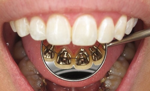 Niềng răng móm cho hàm răng đều đặn chuẩn khớp cắn 4