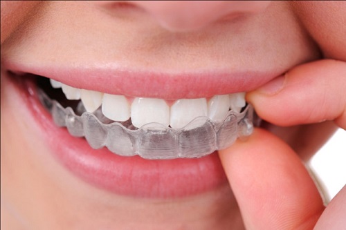 Niềng răng móm cho hàm răng đều đặn chuẩn khớp cắn 5