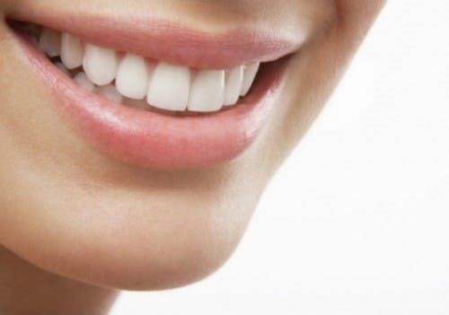 Niềng răng rẻ nhất là bao nhiêu tiền? Có mang kết quả tốt không-4