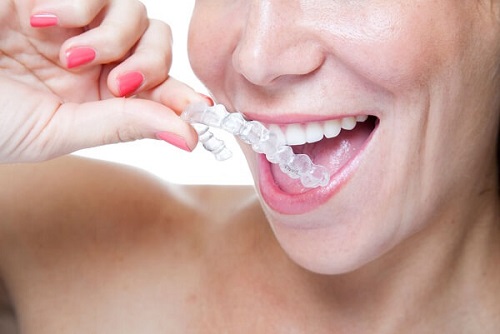 Niềng răng tháo lắp là gì? Có hiệu quả khi áp dụng không?-2
