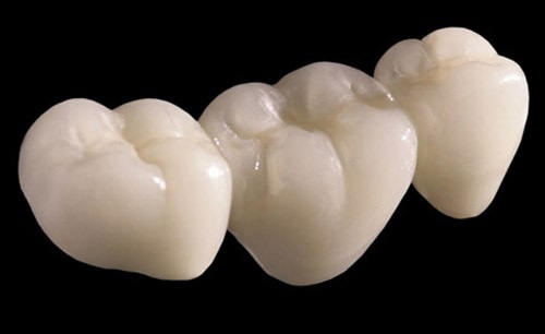 Bọc răng sứ cercon có đắt không so với các răng khác? 2