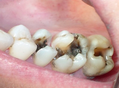 Có nên bọc răng sứ cho răng hàm sâu hay không-1