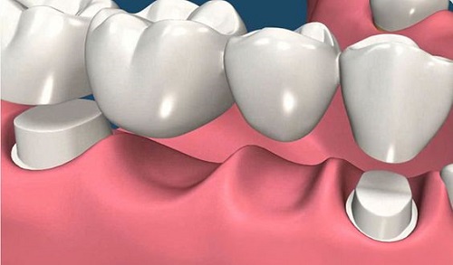 Có nên bọc răng sứ cho răng hàm sâu hay không-2