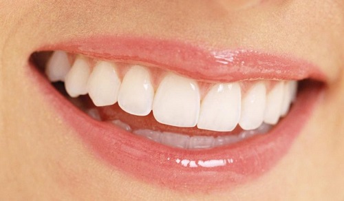 Quy trình bọc răng sứ cho răng cửa mọc lệch 1
