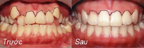 Quy trình bọc răng sứ cho răng cửa mọc lệch 2