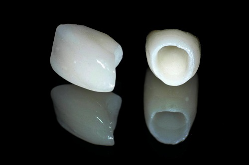 Quy trình bọc răng sứ cho răng cửa mọc lệch 4
