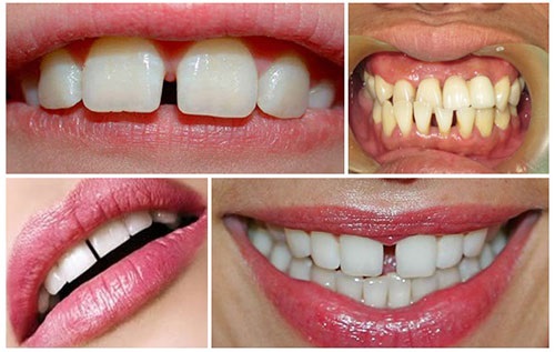 Bọc răng sứ cho răng thưa bao nhiêu tiền hợp lý? 1