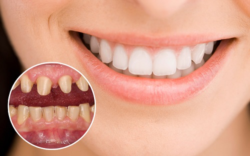 Bọc răng sứ có được vĩnh viễn không khi hoàn thiện? 1