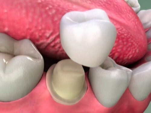 Bọc răng sứ có tháo ra được không? Nên tháo khi nào? 1