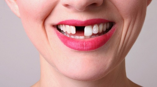 Bọc răng sứ khi mất răng như thế nào là tốt? 1
