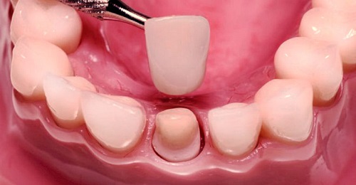 Có nên bọc răng sứ cho trẻ em? Vì sao? 1