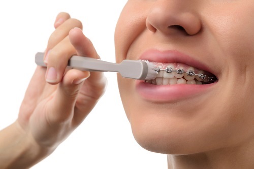 Tình trạng ê buốt khi niềng răng do đâu? Cách khắc phục nhanh-4 Tình trạng ê buốt khi niềng răng do đâu? Cách khắc phục nhanh-4