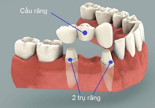 Làm cầu răng sứ xử lý khuyết điểm mất răng-1