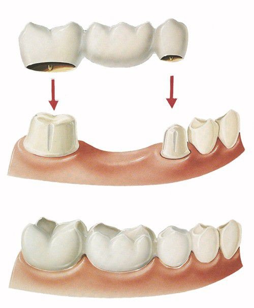 Làm cầu răng sứ xử lý khuyết điểm mất răng-2