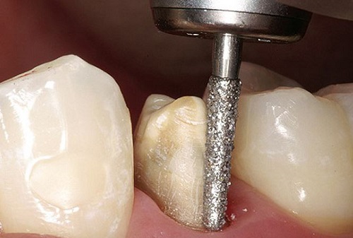 Làm cầu răng sứ xử lý khuyết điểm mất răng-3