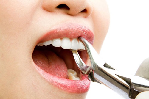 Nhổ răng khểnh giúp phòng tránh bệnh răng miệng 2