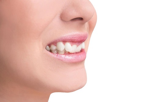 Nhổ răng khểnh giá bao nhiêu 1 cái? 1 Nhổ răng khểnh giá bao nhiêu 1 cái? 1