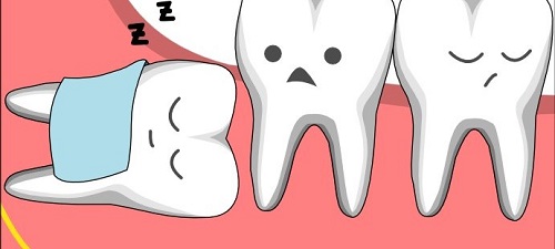 Nhổ răng khôn có tốt không? Trường hợp nào nên nhổ răng khôn 1