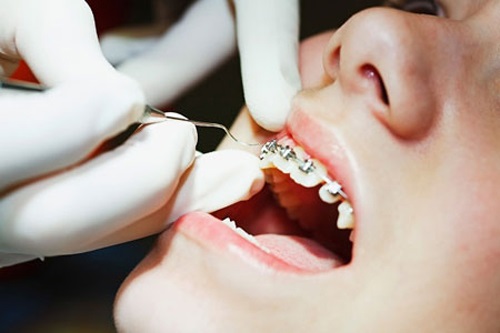 Niềng răng 1 hàm có đau không với mắc cài sứ? 2