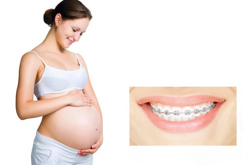 Niềng răng bao lâu thì nên có bầu vậy bác sĩ?-1