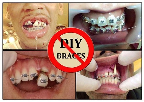 Cách xử lý niềng răng bị hỏng cho bạn-1