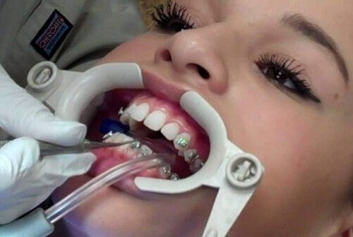 Cách xử lý niềng răng bị hỏng cho bạn-2
