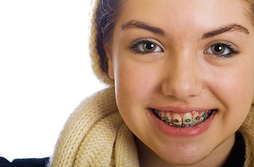 Cách xử lý niềng răng bị hỏng cho bạn-4