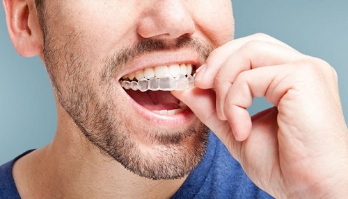 Nguyên nhân chính dẫn đến niềng răng bị hóp má là gì?-4