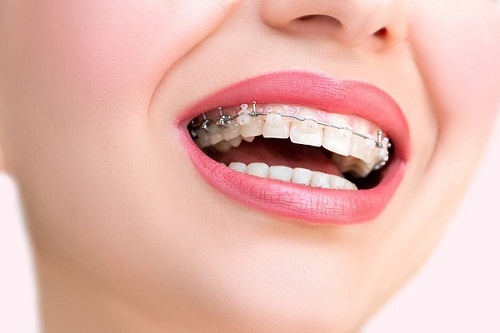 Niềng răng bị lòi chân răng? Giải pháp từ chuyên gia-1