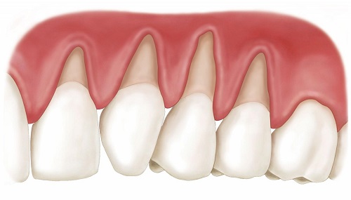 Niềng răng bị lòi chân răng? Giải pháp từ chuyên gia-2