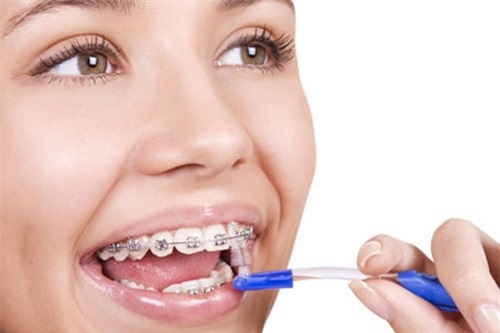 Theo bạn niềng răng có làm răng yếu đi không?-3