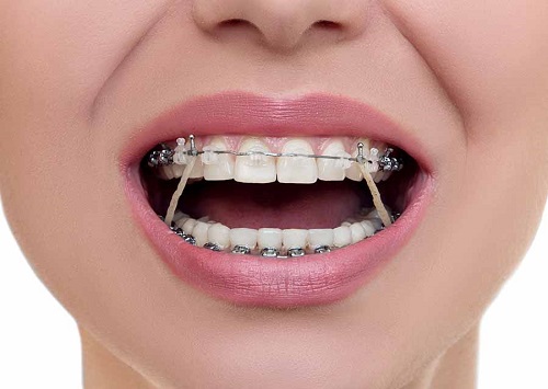 Niềng răng giai đoạn nào đau nhất trong quá trình niềng?-1