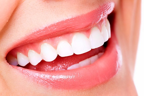 Niềng răng hàm trên bao nhiêu tiền là đảm bảo?-4