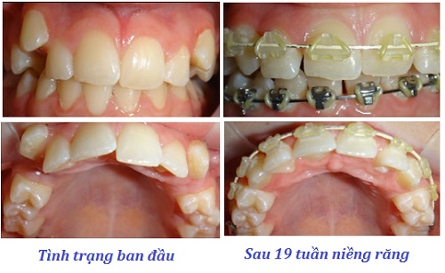 Niềng răng hàm trên mất bao lâu là răng thẳng đều? 3