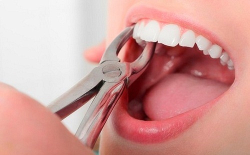 Thực hiện niềng răng hô có phải nhổ răng không bác sĩ?-1
