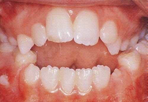 Điều trị niềng răng khớp cắn hở hiệu quả tại nha khoa-1