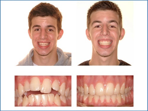 Điều trị niềng răng khớp cắn hở hiệu quả tại nha khoa-2