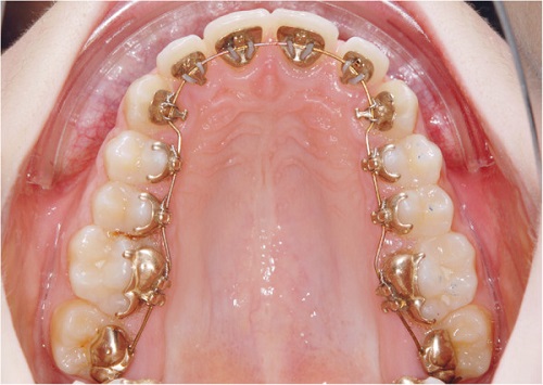 Phương pháp niềng răng mắc cài mặt lưỡi với ưu điểm vượt trội-1