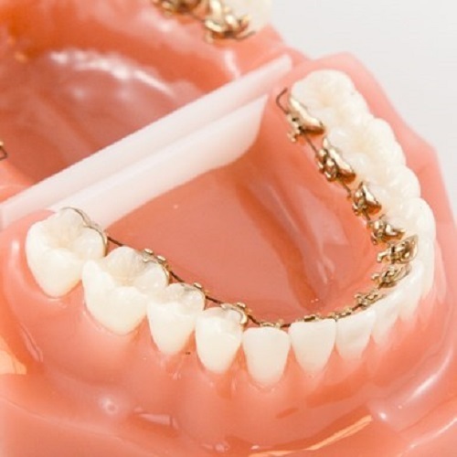 Phương pháp niềng răng mắc cài mặt lưỡi với ưu điểm vượt trội-3