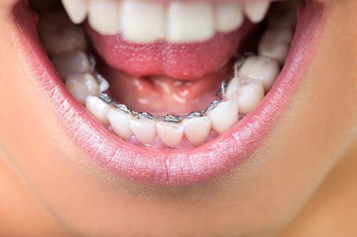 Niềng răng mặt trong giá rẻ có nên thực hiện không? 1