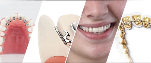 Niềng răng mặt trong giá rẻ có nên thực hiện không? 2
