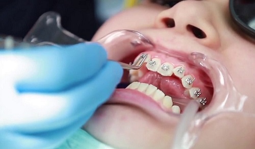 Niềng răng người lớn giá bao nhiêu? Hiệu quả có tương ứng với mức giá không-4