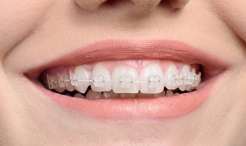 Khảo sát niềng răng pha lê giá bao nhiêu tiền hiện nay cho bạn-1