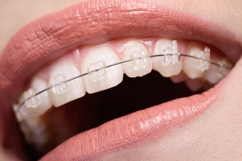 Làm thế nào để chọn được dịch vụ niềng răng rẻ nhất Hà Nội-3 Làm thế nào để chọn được dịch vụ niềng răng rẻ nhất Hà Nội-3