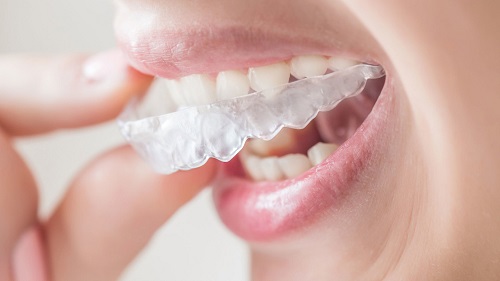 Làm thế nào để chọn được dịch vụ niềng răng rẻ nhất Hà Nội-4 Làm thế nào để chọn được dịch vụ niềng răng rẻ nhất Hà Nội-4