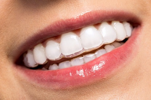 Niềng răng trong suốt có tốt không cho răng thưa? 2