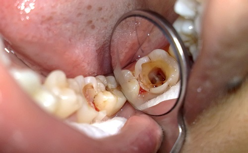 Bọc răng hàm bị sâu có đau không? Tư vấn từ nha khoa-2
