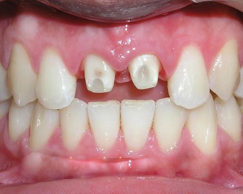 Bọc răng sứ có bị rớt ra không? Cần tìm hiểu ngay-2