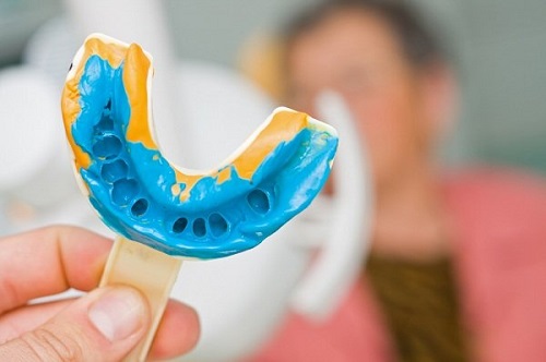 Bọc răng sứ có bị rớt ra không? Cần tìm hiểu ngay-3
